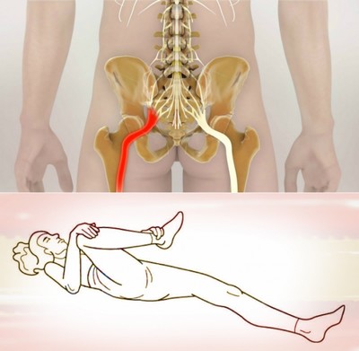 Как разблокировать седалищный нерв: 2 простых способа снять боль
